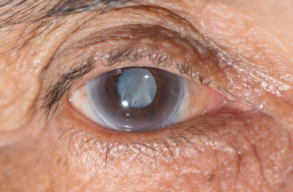 Cataract Surgery in Pakistan: Procedure & Recovery Guide