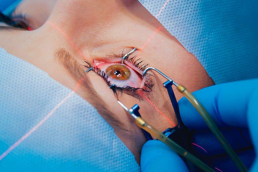 SMILE Pro Surgery: A Surgeon's Guide to Laser Vision