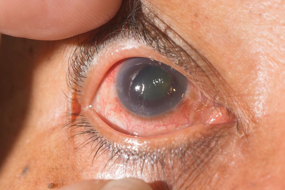 Glaucoma Treatment in Pakistan: Symptoms, Tests & Surgery