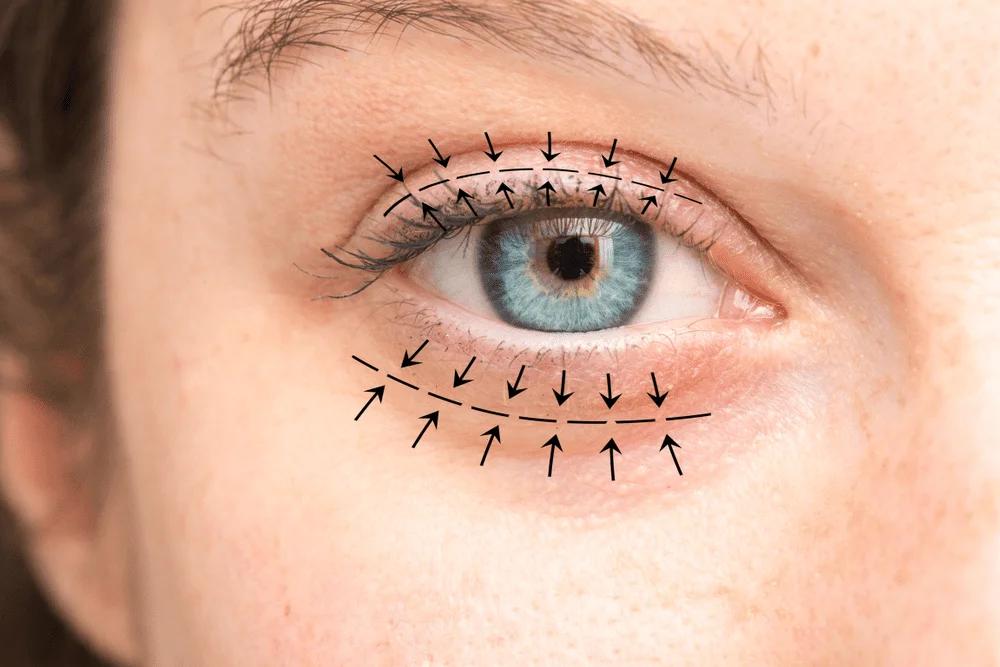 Oculoplasty: Eyelid, Ptosis and Tear Duct Surgery Explained