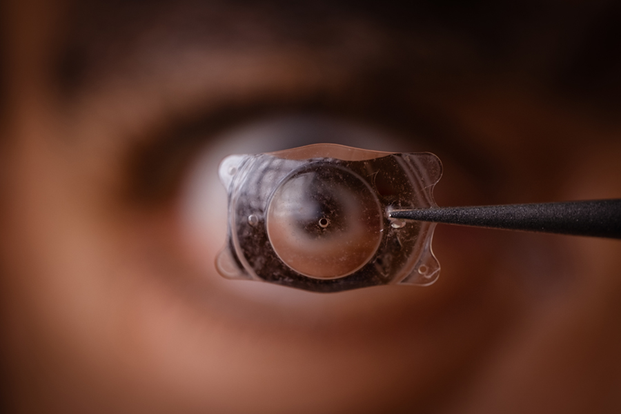 IMPLANTABLE COLLAMER LENS - ICL